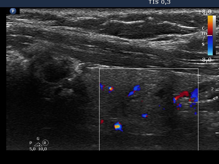 Right lobe, longitudinal scan