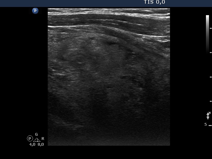 Right lobe, longitudinal scan