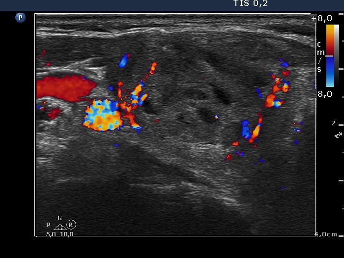 Right lobe, longitudinal scan