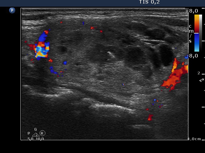 Right lobe, longitudinal scan
