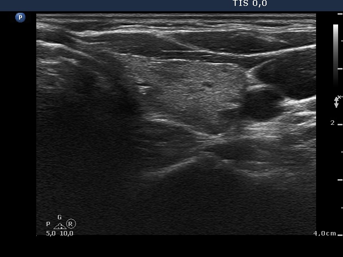 Right lobe, longitudinal scan