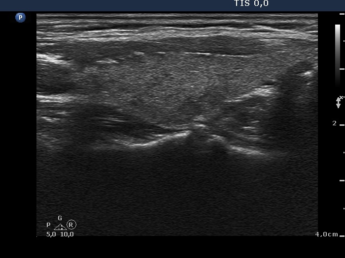 Right lobe, longitudinal scan