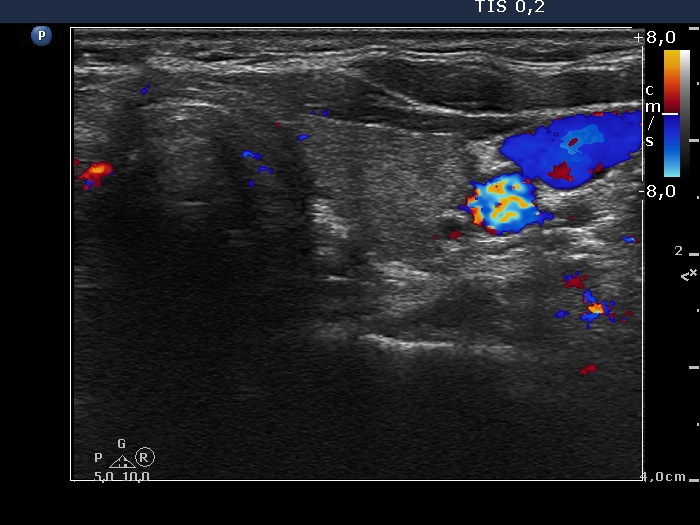 Right lobe, longitudinal scan