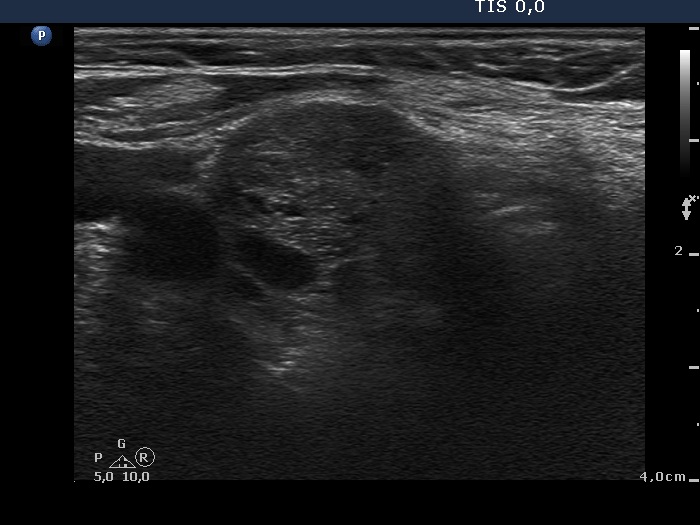 Right lobe, longitudinal scan