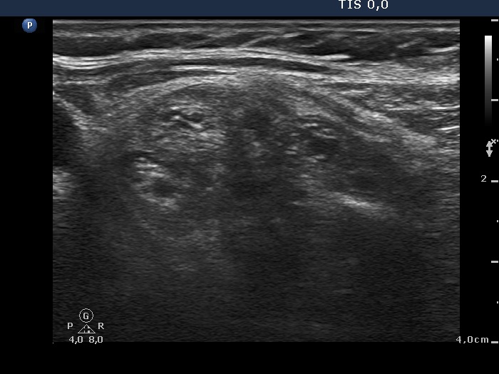 Right lobe, longitudinal scan