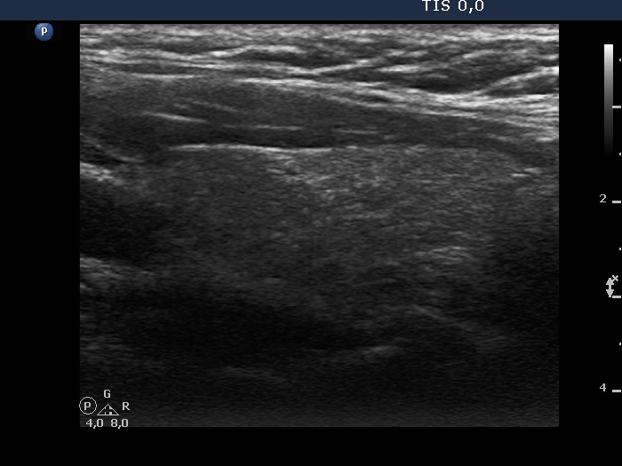 Right lobe, longitudinal scan