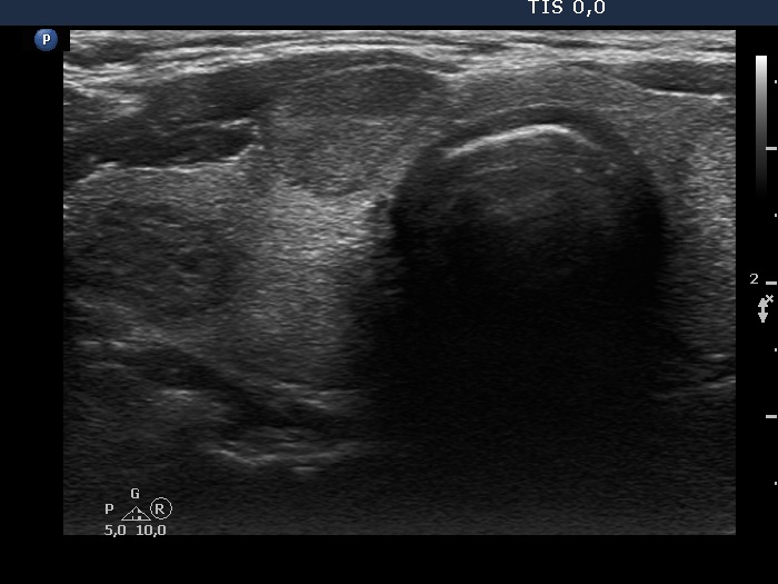 Right lobe, longitudinal scan