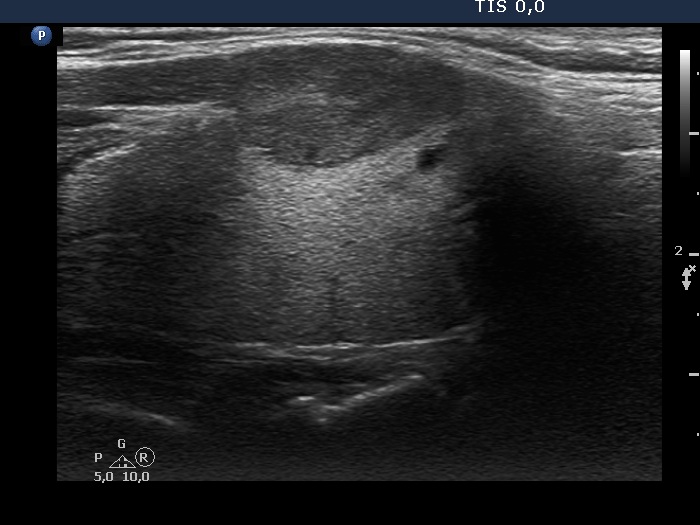 Right lobe, longitudinal scan