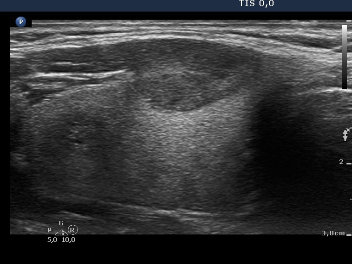 Right lobe, longitudinal scan