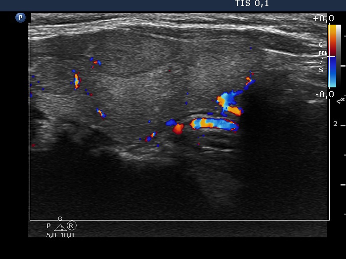 Right lobe, longitudinal scan