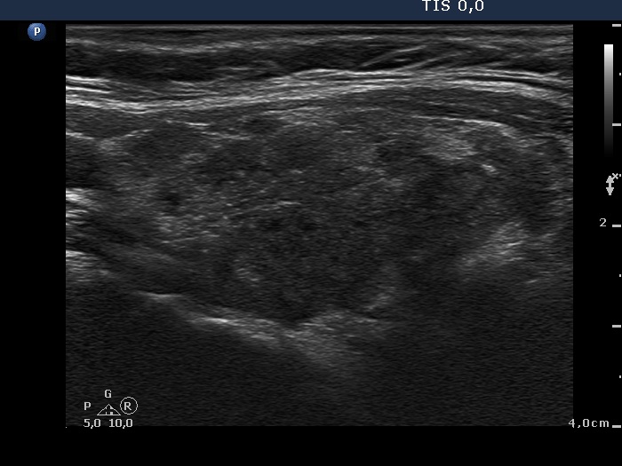 Right lobe, longitudinal scan