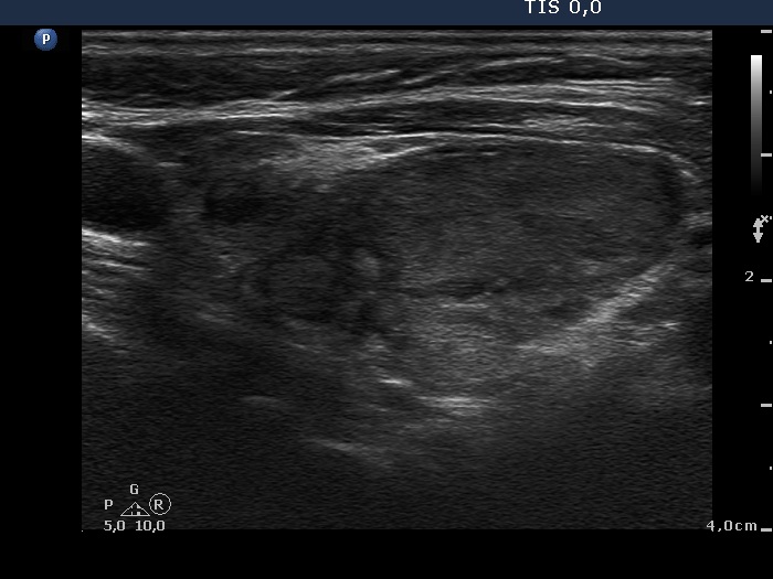 Right lobe, longitudinal scan