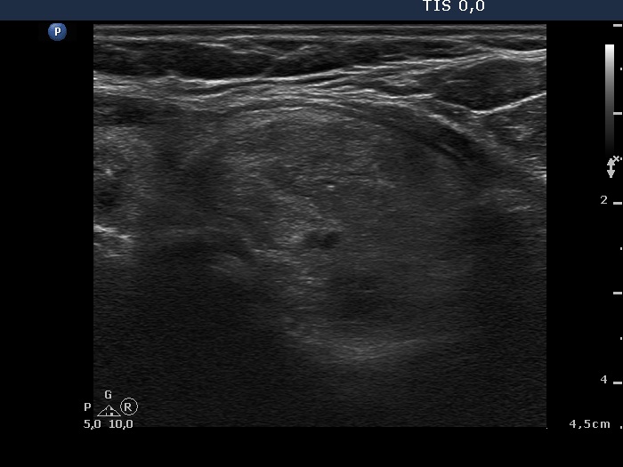 Right lobe, longitudinal scan