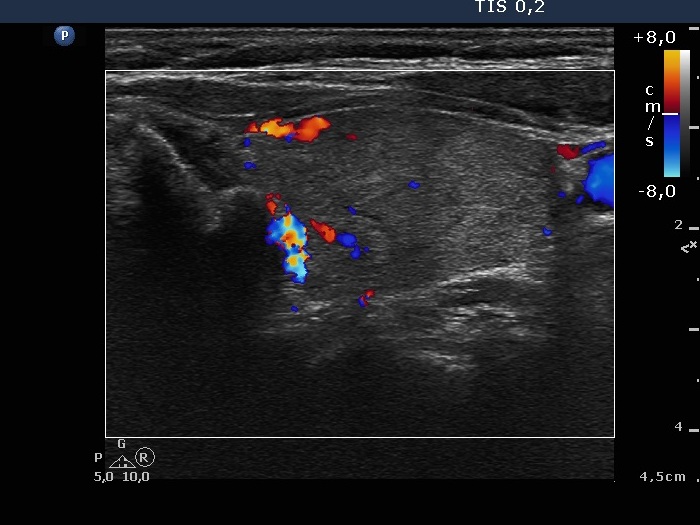 Right lobe, longitudinal scan
