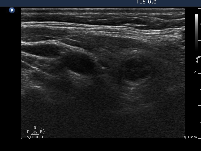 Right lobe, longitudinal scan