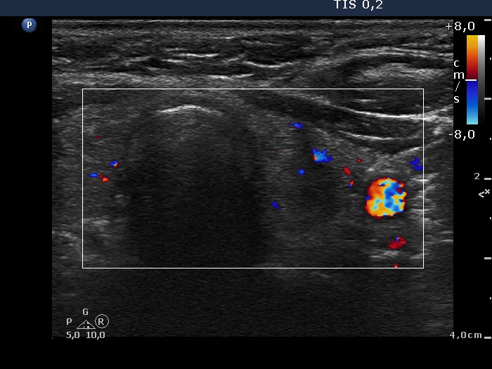 Right lobe, longitudinal scan