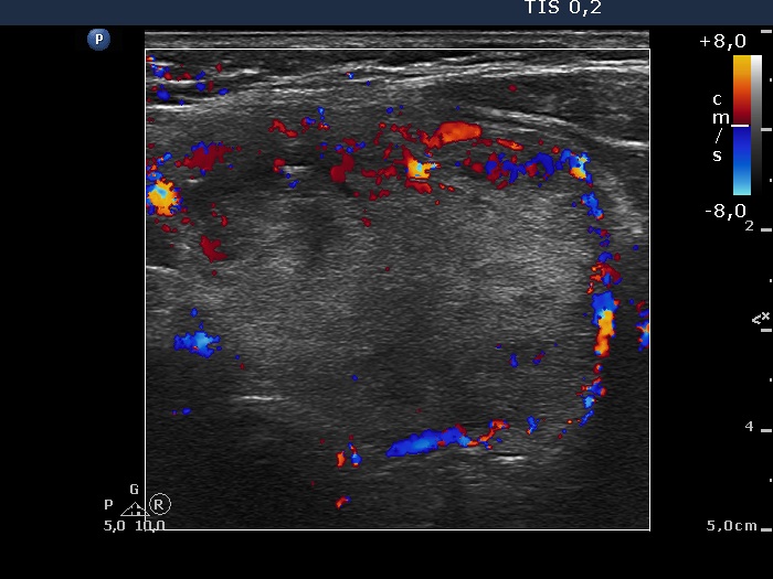 Right lobe, longitudinal scan