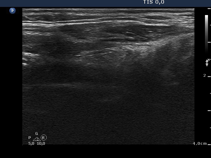 Right lobe, longitudinal scan