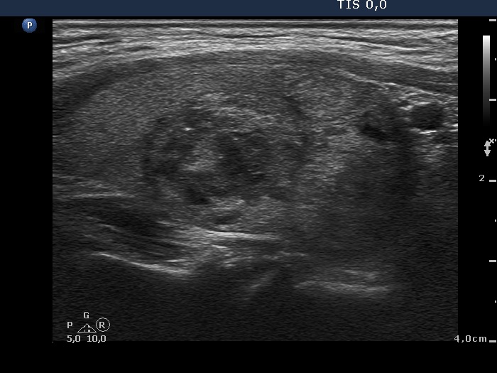 Right lobe, longitudinal scan