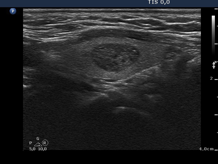 Right lobe, longitudinal scan
