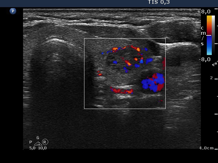 Right lobe, longitudinal scan