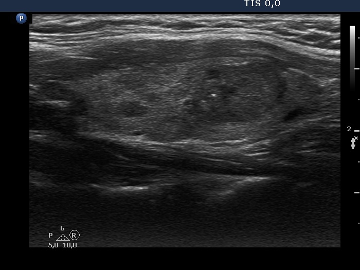 Right lobe, longitudinal scan