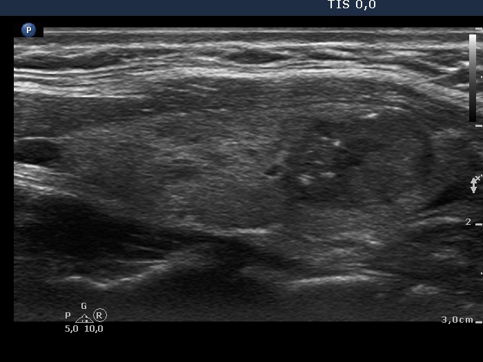 Right lobe, longitudinal scan