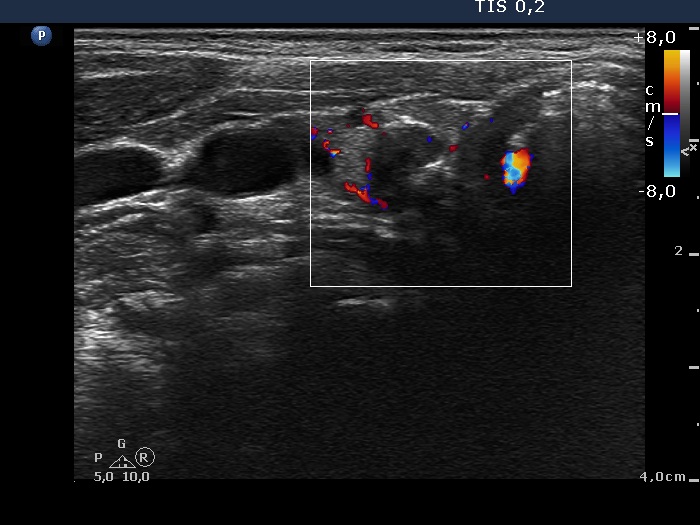 Right lobe, longitudinal scan