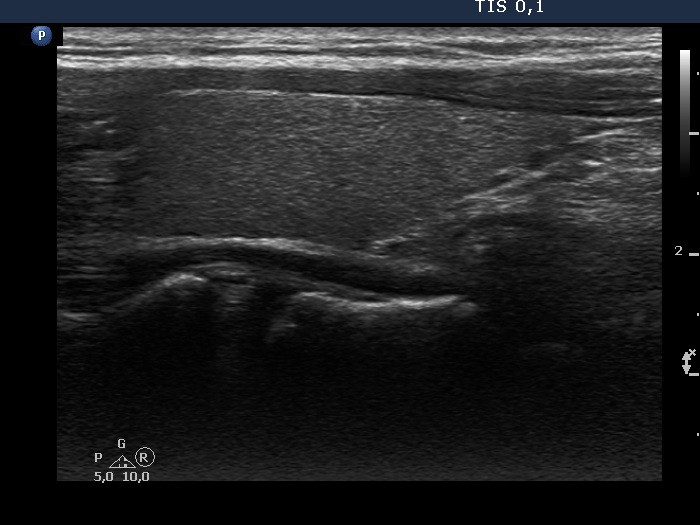 Right lobe, longitudinal scan