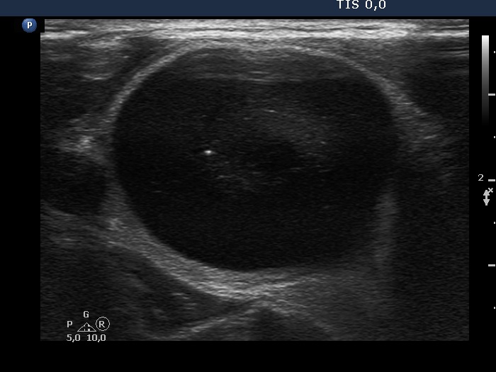 Right lobe, longitudinal scan