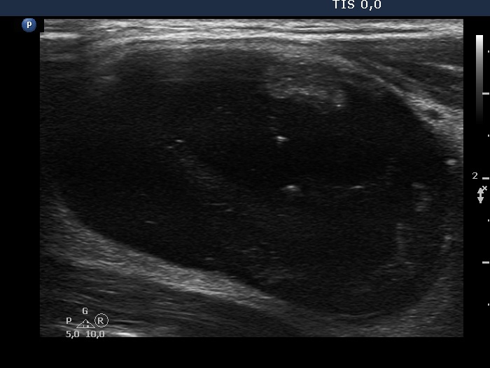 Right lobe, longitudinal scan
