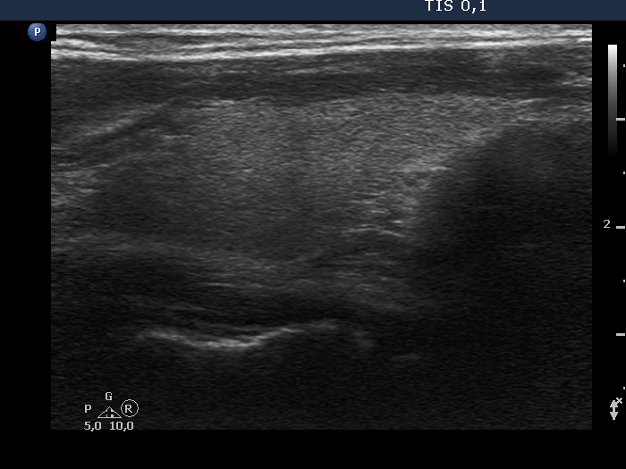 Right lobe, longitudinal scan