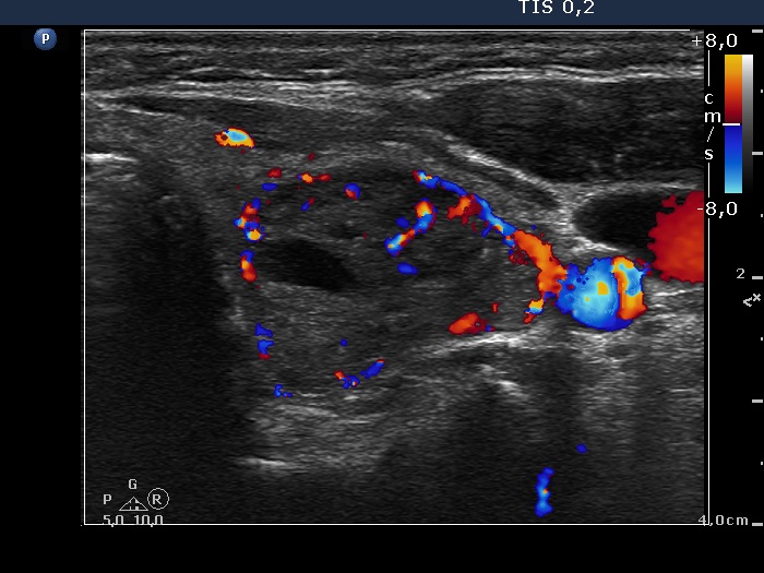 Right lobe, longitudinal scan