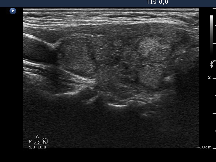 Right lobe, longitudinal scan