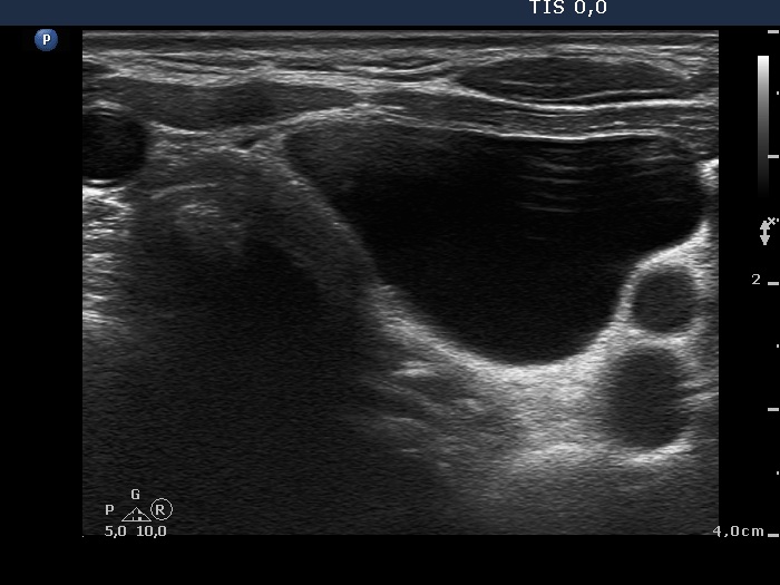 Right lobe, longitudinal scan