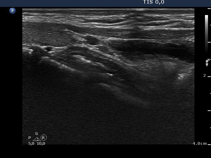 Right lobe, longitudinal scan