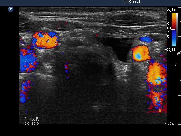 Right lobe, longitudinal scan