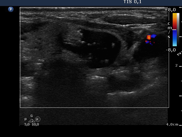 Right lobe, longitudinal scan