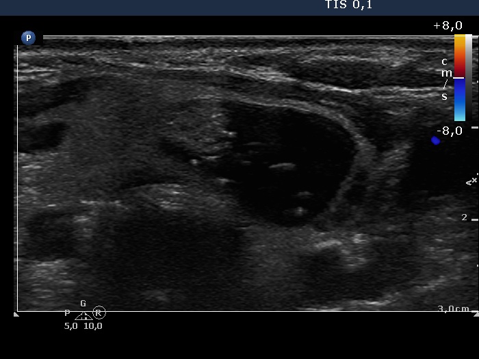 Right lobe, longitudinal scan