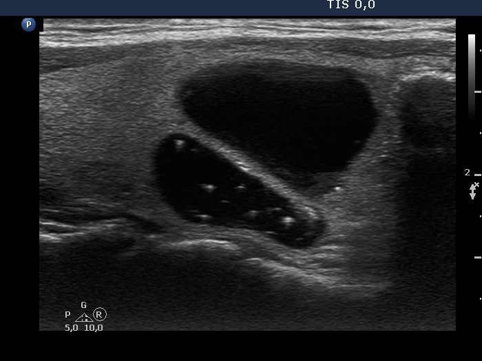 Right lobe, longitudinal scan