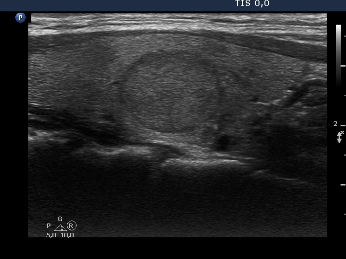 Right lobe, longitudinal scan
