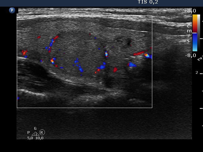 Right lobe, longitudinal scan