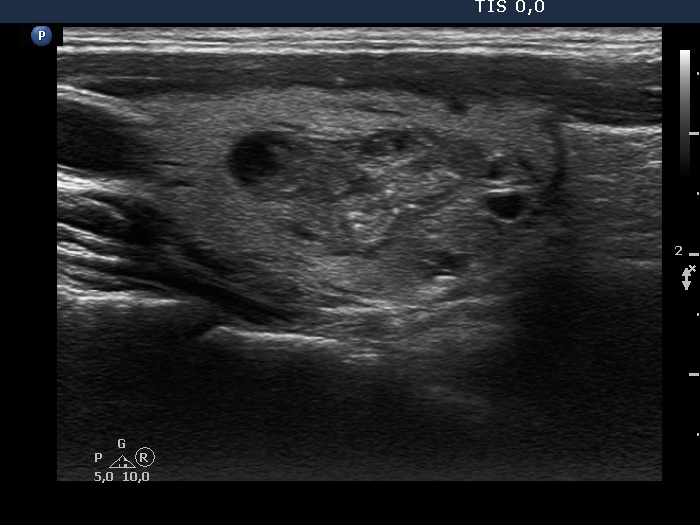 Right lobe, longitudinal scan
