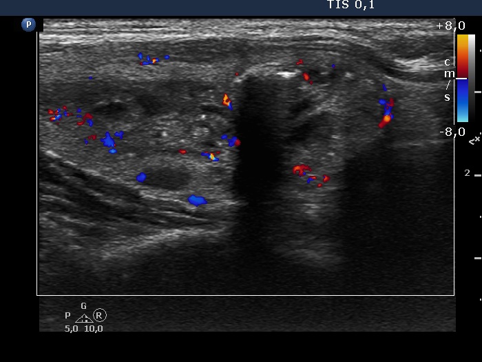 Right lobe, longitudinal scan