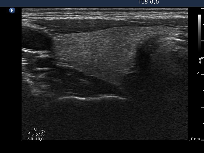 Right lobe, longitudinal scan