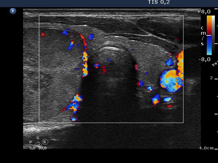 Right lobe, longitudinal scan