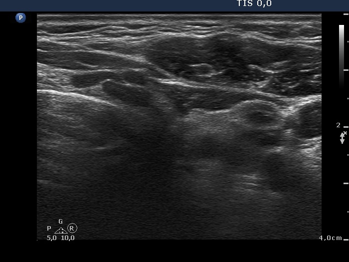 Right lobe, longitudinal scan