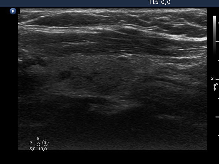 Right lobe, longitudinal scan