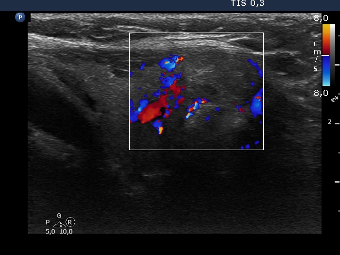 Right lobe, longitudinal scan