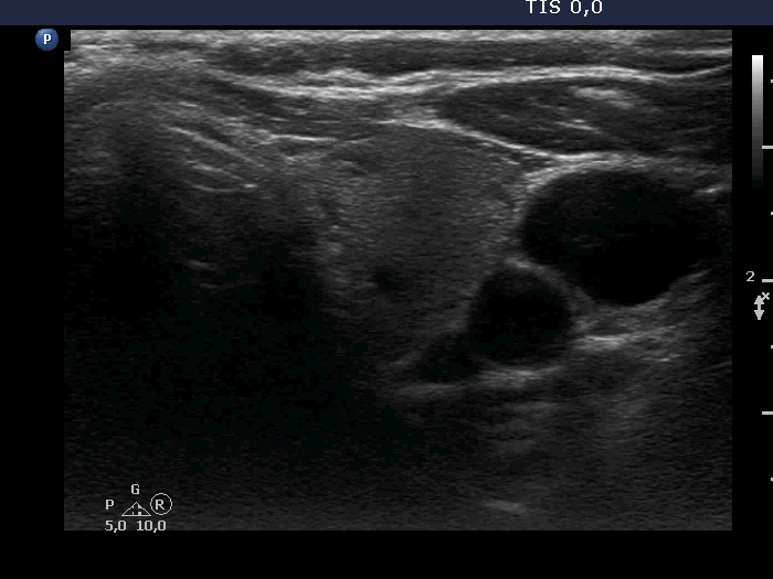 Right lobe, longitudinal scan